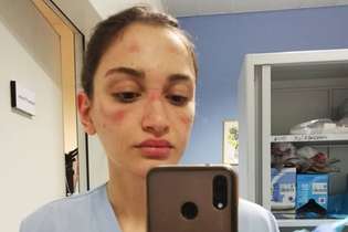 A enfermeira italiana Alessia Bonari fez seu relato com o rosto ainda marcado pelo uso dos equipamentos de proteção